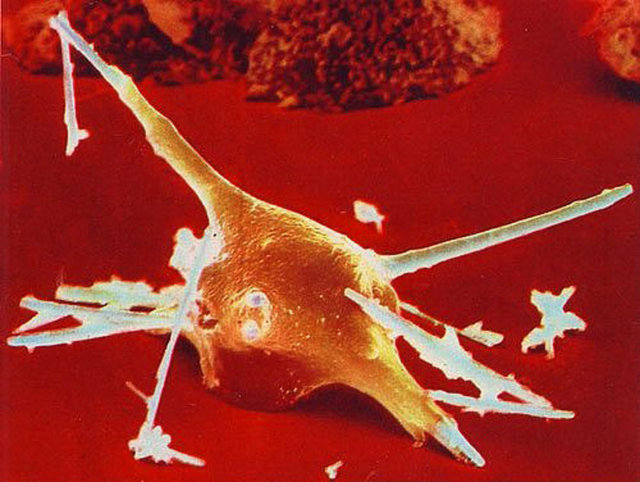 İnsan soyunun karşılaştığı en büyük tehlikelerden biri olan kanserojen mineral "Asbest"in Makrofaj tarafından yakalanması.