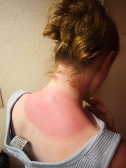 Dr. Behiç Berk Kuğu,güneş yanığı olan bölgeye yoğurt veya diş macunu sürmenin enfeksiyon riskini artırdığını belirterek