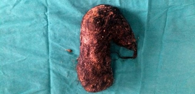 İnsan midesinden çıkan en ilginç şeylerBursa'da 15 yıldır saç yeme hastalığı olan kadının midesindeki 850 gram saç çıktı.