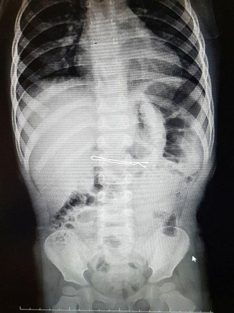 İzmir'deki Tepecik Eğitim ve Araştırma Hastanesi Çocuk Gastroenteroloji Bölümü'nün, yabancı cisim yutan çocukların nefes ve borusu ile midelerinden çıkarttığı, anahtarlık, madeni para, saat pili, ataç, çengelli iğne ve çivi gibi objeler görenleri şaşkına çevirdi.