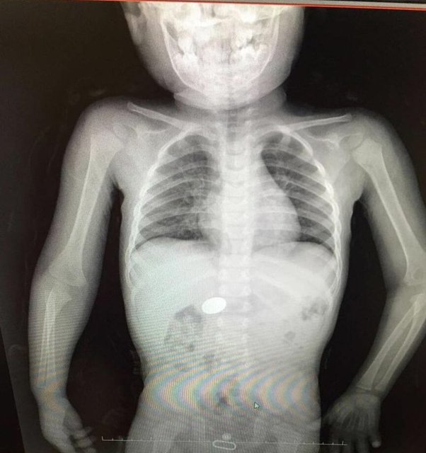 Bu yaş grubu çocuğunuz varsa kendinden biraz daha büyük, olgunluğa erişmemiş çocuklarla ya da kardeşleriyle yalnız bırakmamanız gerekiyor. Bazen büyük çocuklar, çocuğun eline yabancı cisim verebiliyor. Kıyafetlere taktığımız nazar boncuğu ve çengelli iğneleri çocuklar 6 aydan sonra alıp yutabiliyorlar. 