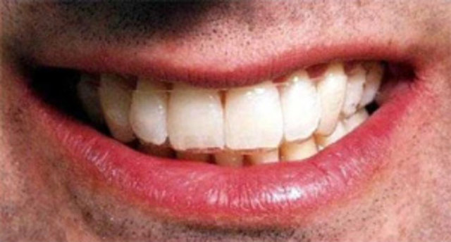 Görünmez Diş Teli: Uzay araçlarında kullanılan materyaller artık diş tellerinin neden olduğu görüntülerin yaşanmasını önlüyor. -