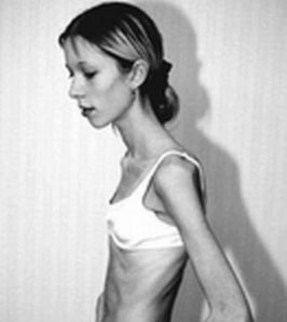 Isabelle Caro, Ana Carolina Reston, ve Hila Elmalich anoreksi nedeniyle hayatını kaybeden mankenlerden sadece 3'ü.