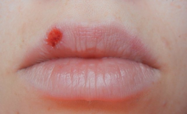 Dudağınızda tuhaf bir şişme hissedersiniz. Bir de bakmışsınız ki uçuk çıkmış.