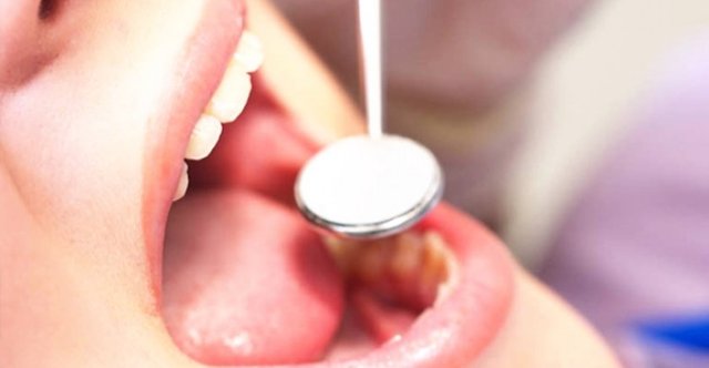 Dikkat edilmediği takdirde erken yaşlarda diş kayıpları görülmektedir.