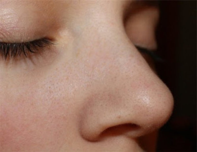 Bu görüntü her insan için geçerli fakat yağ salgısı fazla olan kişilerde gözenekler de daha geniş.