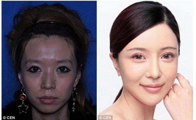 Şarkıcı Zhang Cher'in ameliyat öncesi ve sonrası.
