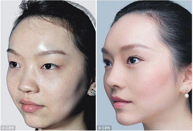 Lin Wen burun estetiği, göz kapağı ameliyatı, botox ve kirpik estetiği olmuştur.