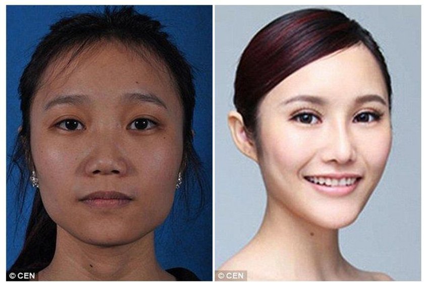 Изменение формы глаза. Кореянки до и после операции на глаза. Пластическая операция разрез глаз. Пластика глаз кореянки. Корейцы до и после пластики глаз.