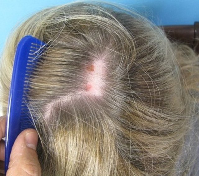 Bu kişiler saçları haricinde vücutlarında kaşları, kirpikleri, sakalları gibi vücutlarındaki diğer kılları da çekme isteği duyuyor. Bu takıntı çoğunlukla vücutta kolay fark edilebilir kelliklere yol açıyor.