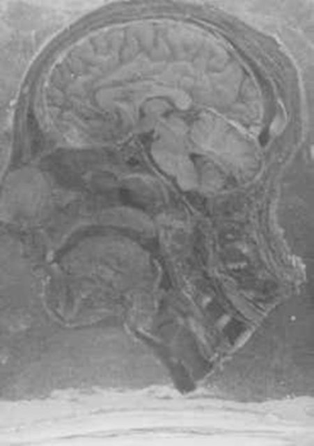 İkiye ayrılmış insan kafası