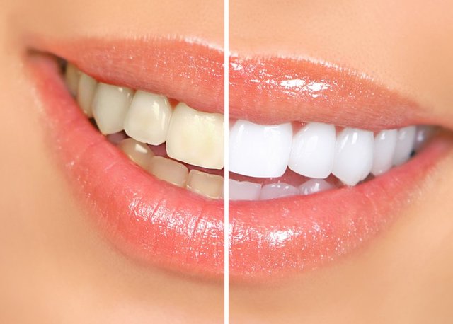 Dişlerin yapısındaki renklenmelerin veya koyu renkli dişlerin daha estetik bir görüntü vermek amacıyla beyazlatılması işlemi, 'Bleaching' olarak adlandırılır.