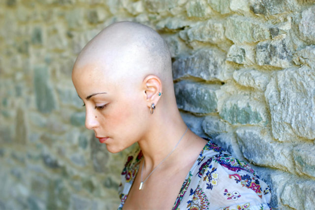 Kemoterapinin etkisi ile saç dökülmesi yaşanabilir ancak kemoterapi bittikten sonra saçların daha da gür çıktığı da unutulmamalıdır.