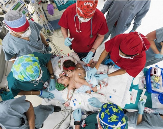 Houston kentindeki Teksas Çocuk Hastanesi cerrahlarından Dr. Darrell  Cass, ikizlerin dünyaya geldiği nisan ayından bu yana hazırlık yaptıkları  ameliyatın başarılı geçtiğini söyledi.