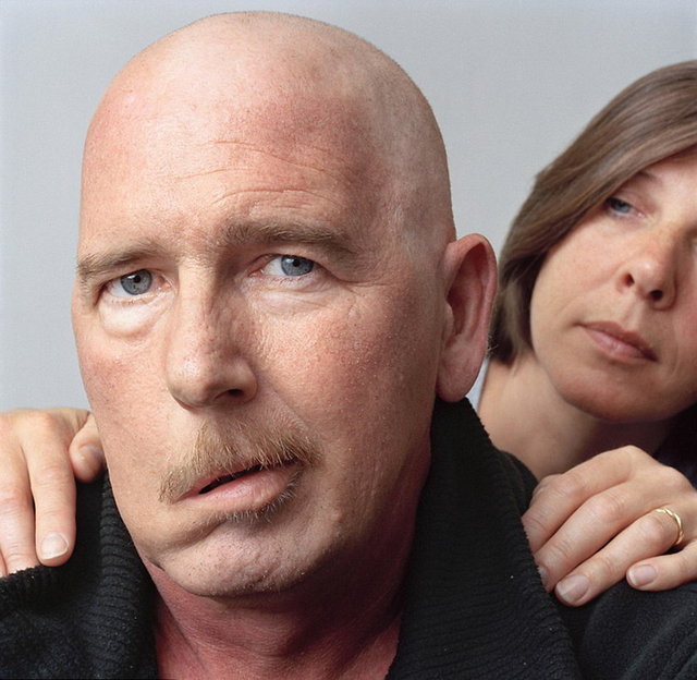 Kafatası ve yüz kemiği kırıkları