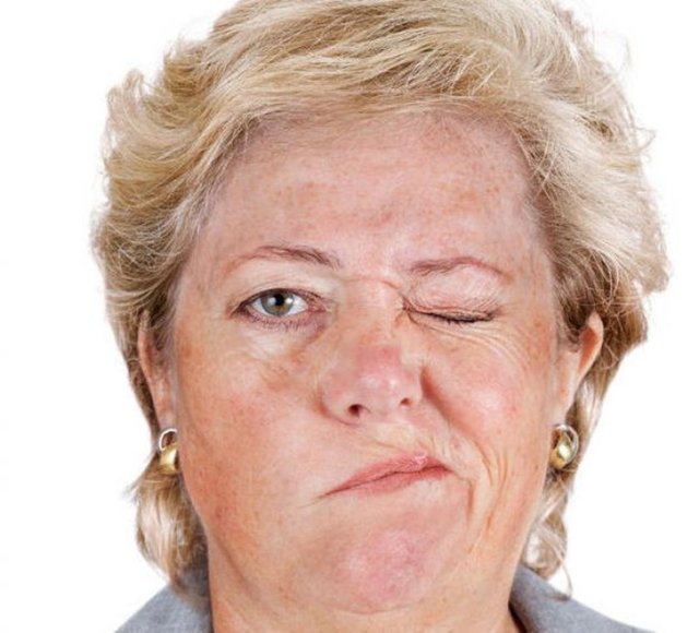 Göz kapağı, ağız hareket ettirilemez. Yüz felci sebep olan faktöre göre kalıcı veya geçici olabilir.