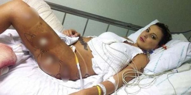 Daha önce de sepsis olan ve Sao Paulo'da acil olarak ameliyata alınan Andressa Urach'ın sol bacağını kaybetme riskinin yanı sıra hayatı da tehlikedeydi.
