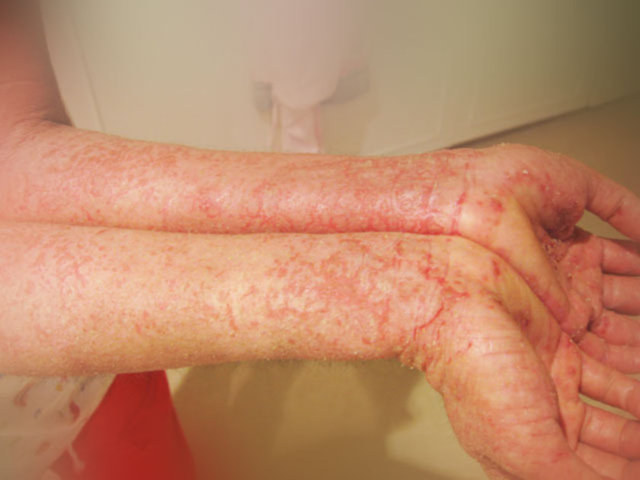 Kimyasallara karşı oluşanlarda ise durum biraz daha farklı. Kimyasallar, el derisinin bariyerinin bozulmasına neden olur.