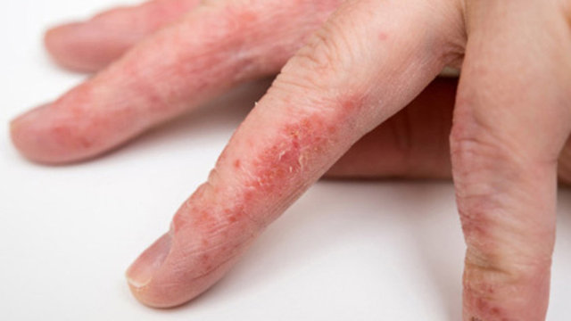 Egzama, kaşıntılı bir deri hastalığıdır. Alerjenlere ve kimyasallara karşı oluşan olmak üzere ikiye ayrılırlar.