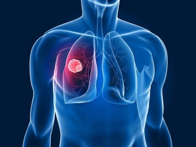 Bir akciğer hastalığı olan KOAH amfizem ve kronik bronşiti kapsıyor. KOAH'nın en sık görülen belirtisi, akciğere giren ve akciğerden çıkan havayı nefes darlığına neden olacak derecede kısıtlamasıdır.