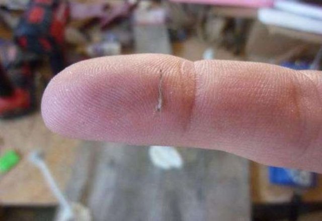 Kıymığın üzerine bir dilim sarımsağı yerleştirin ve parmağınızı bandajla sarın.