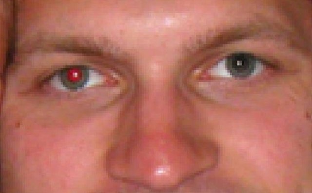 Eğer bir fotoğrafınızda sadece bir gözünüz kırmızı çıktıysa, bu retinoblastom (bir çeşit göz kanseri) belirtisi olabilir.