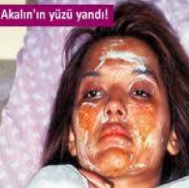 DEMET AKALIN Uçan balondan yanmıştim yıllar yıllar önce! Tekrar uyarıyım dedim! Bebeklere gazlı balon asla almayın! Güzel bi #tbt olmadı ama... Çok acılı yıldı...