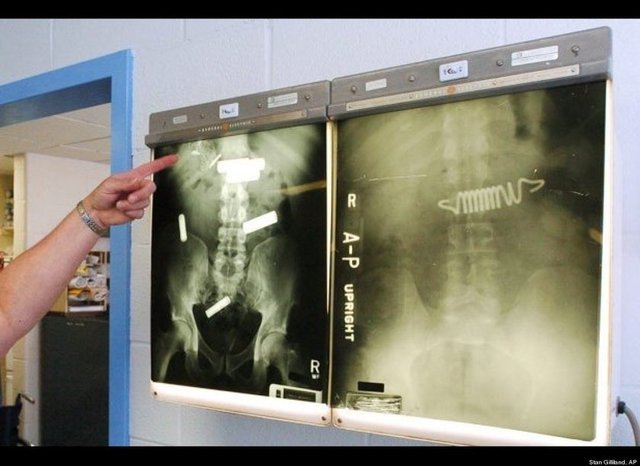 Newyork'taki bir hapishanede yatak yayı ve pil yutan mahkumların röntgen görüntüsü...