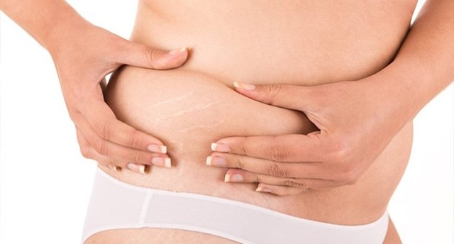 Karın başta olmak üzere deri çatlakları gelişir.  -