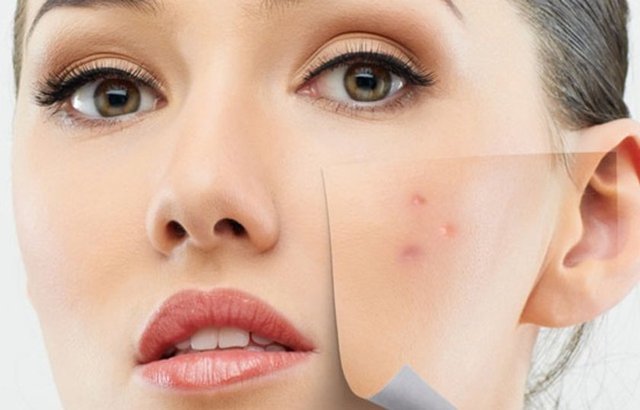 Yağ salgısının artmasıyla sivilceler görülür.