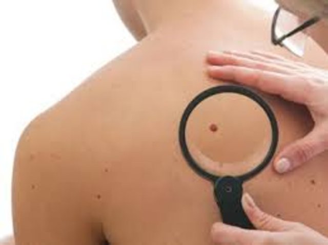 Boyun, koltukaltı, meme altı, kasık gibi bölgelerde deri siyahlaşması, kalınlaşması ve et benleri oluşabilir.  -