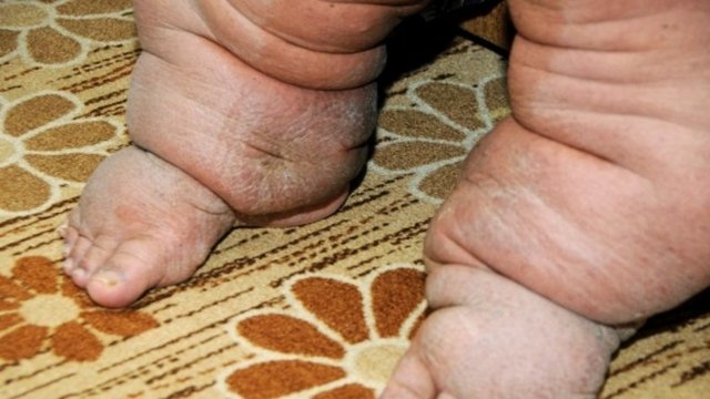 Lenf (akkan) akımı bozulmasına bağlı lenfödem (özellikle bacaklarda aşırı şişme) oluşur. Lenfosit  fil ayağı görünümüne neden olur.  -