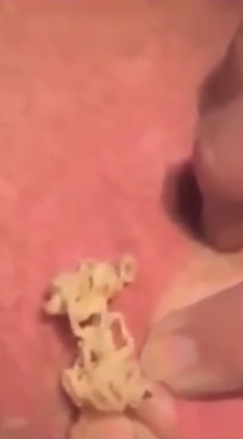 Sıkılınca içlerinden kötü kokulu beyaz sarı renkli bir materyal çıktığını, bu kistlerin sıkılmaması gerektiğini,