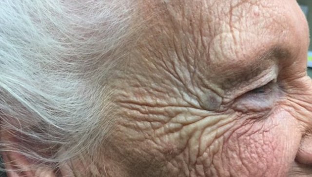 Vakit kaybetmeden doktora giden kadına hemen müdahale edildi. Zaten tedavi gördüğü hastanenin doktoru, küçük bir kesiyle şakağındaki kitleyi aldı.