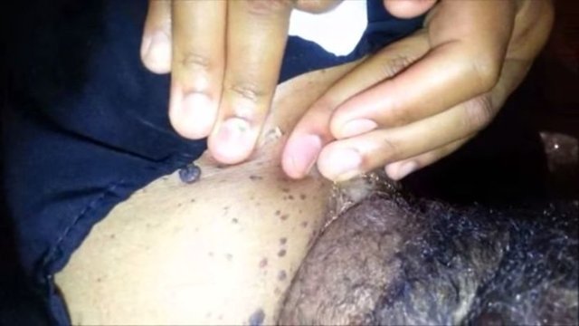 Siyah nokta gibi görünen bu oluşumlar, yardımcı kişinin "Siyah noktanı sıkacağım" demesine kalmadan fışkırmaya başlıyor.