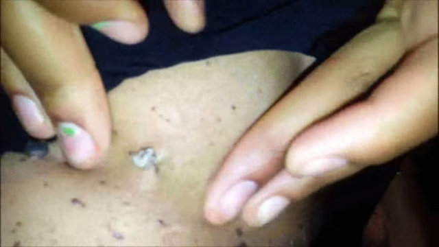 İçerideki sıvı bitmek bilmiyor... Ayrıca sıkan kişi bu iltihabın çok kötü koktuğunu sözlerine ekliyor.