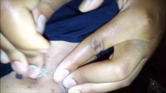 Uzmanlar, epidermal kistlerin zaman içinde yavaş yavaş büyüyüp, bazen iltihaplanıp kızarıp şişebileceğini ve  ağrılı olabileceğini açıklarken,