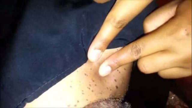 Bu kistlerin içindeki materyal siyah noktada olanla benzer ancak siyah noktada gözenekler tünel şeklinde tıkanır, epidermal kistte ise deri altında bir kese mevcut.