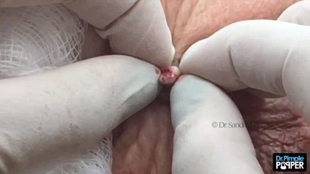 Doktoru Sandra Lee, geçen hafta, yaşlı kadının sol kulağının üst sarmalından da cilt kanserine neden olan bir dokunun alındığını söyledi.