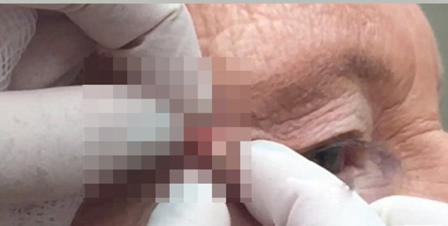 Kanser tedavisi gören yaşlı kadının yıllarca siyah nokta sandığı şey bakın neymiş...