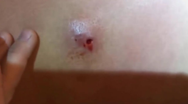 En sonunda tamamen çıkartılan siyah nokta ve iltihabın ardından, hastanın bedeninde koca bir delik açılıyor.