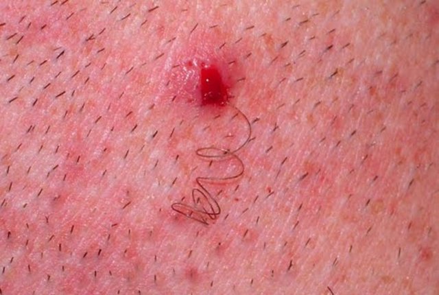 Vücut, içeri doğru gelişen kıla yabancı madde gibi davranır ve burada iltihap oluşur.