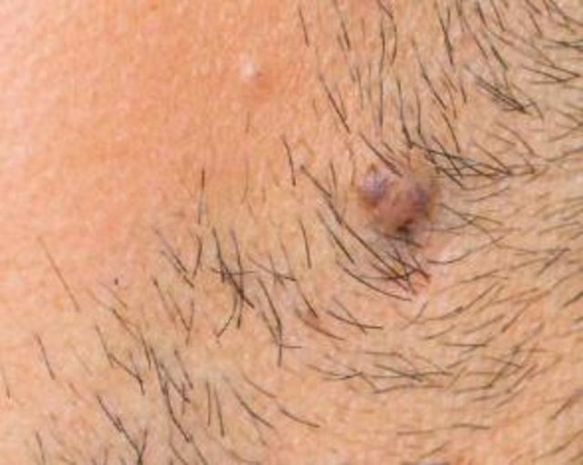 genellikle kuyruk sokumunda görülen bir veya birkaç adet deriye açılmış delik, enflamasyon, şişlik veya apse şeklinde kendini gösteren bir hastalık.