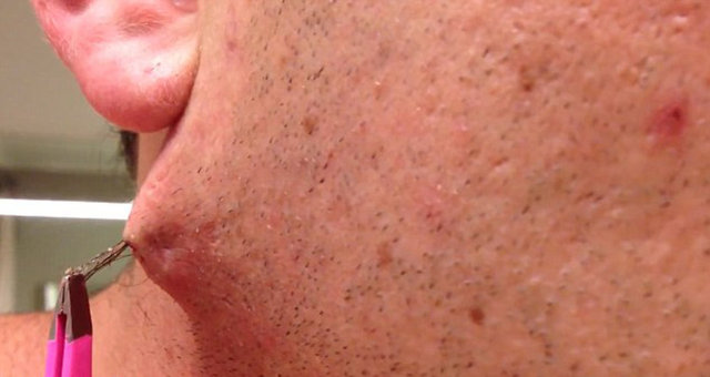 Bunun dışında kalıcı yaralar ve cilt kararması oluşabilir.