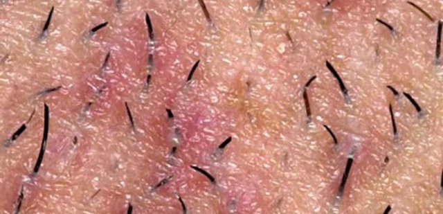 Toplumda oldukça sık rastlanan ve ağrıya neden olan kıl dönmesi, bazı durumlarda acil müdahale gerektirebiliyor.