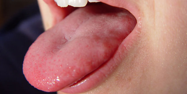 * Dil üzerinde kırmızı / beyaz yama şeklinde lezyon olması ve bu lezyonun zaman içerisinde büyümesi ya da yüzeyden kabarık hale gelmesi