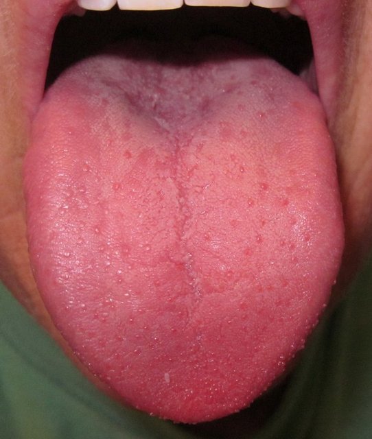 Kulak Burun Boğaz Hastalıkları Uzmanı Dr. Murat Enöz, bu belirtilerden bazıları iyi huylu basit hastalıklarda görülebilse de bu belirtilerin varlığında mutlaka bir Kulak Burun Boğaz uzmanına danışılması gerektiğini söylüyor.