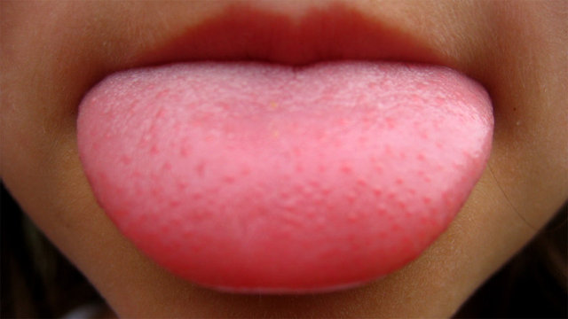 * Dil üzerinde ülserli yara ortaya çıkması,