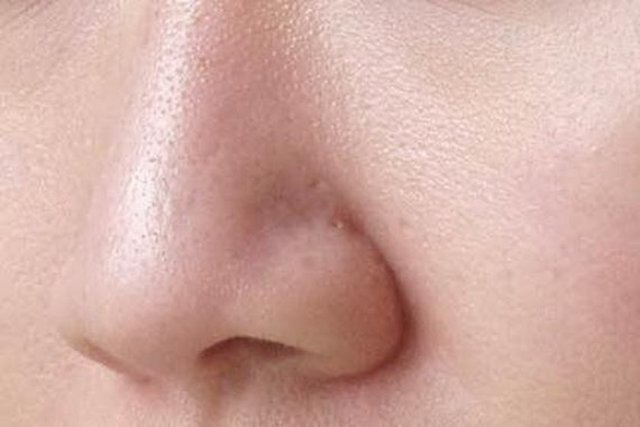 Cildinizdeki geniş gözenekler cildin görünümünü olumsuz yönde etkiler. Ayrıca, yağ ve kir birikimi için uygun ortam sağlar. Sivilce, siyah nokta ve yağ bezesi oluşumunu artırır.