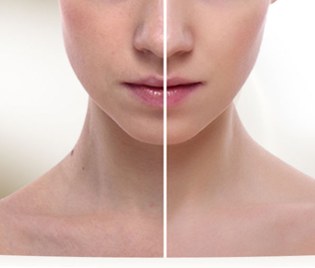 Bu iki malzemeyi kase içerisine iyice karıştırdıktan sonra özellikle duştan sonra genişleyen cilt gözeneklerine pamuk yardımıyla sürün. Kokusu biraz rahatsız edebilir.